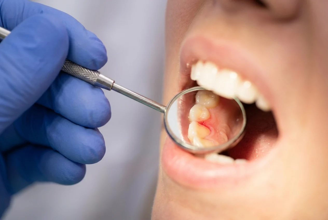 Dentist’s gloved hand and mirror examining healthy teeth and inflamed gums